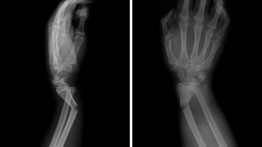 Fractures
